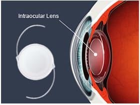 Small incision cataract surgeries