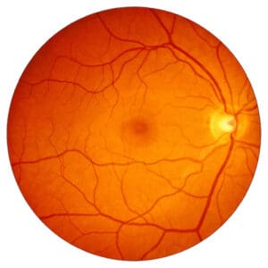 retina treatment normal retina fundus