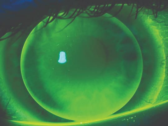 Rigid gas permeable lenses or corneal and refractive treatment