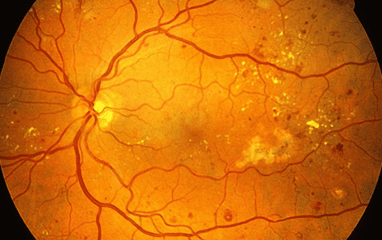 NPDR non-proliferative diabetic retinopathy