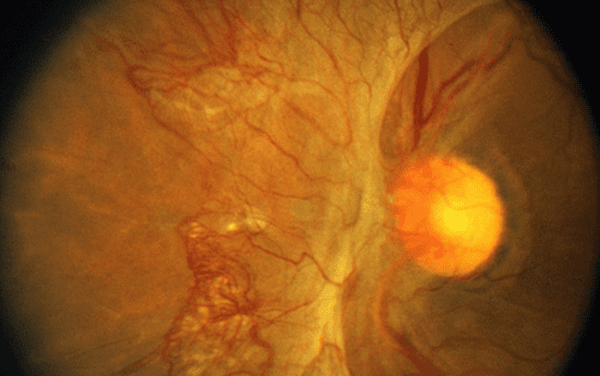 PDR - proliferative diabetic retinopathy