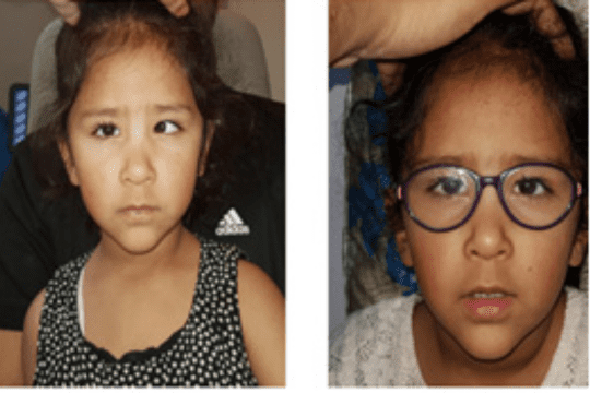 child squint eye treatment at nandadeep eye hospital
