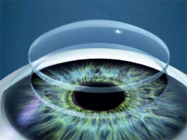 Keratoconus- Causes, Diagnosis & Treatment 