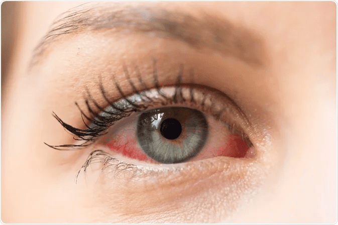 symptoms diabetic retinopathy