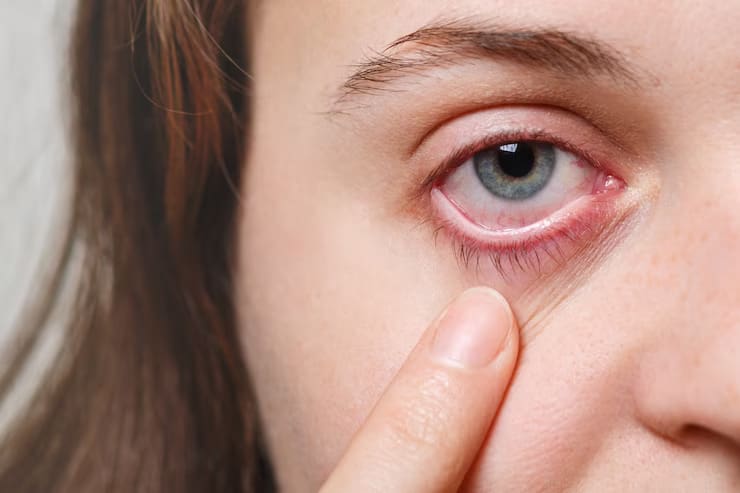 fatigue dry eye symptom and treatment at nandadeep eye hospital