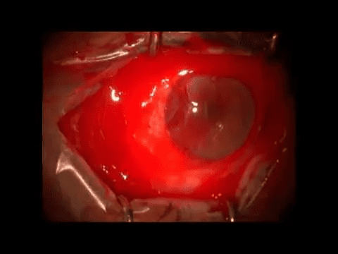 Conjunctival Tumour