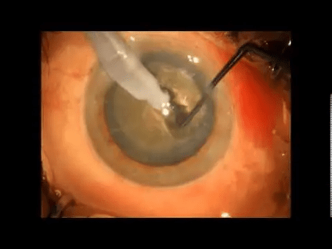 Hard Cataract