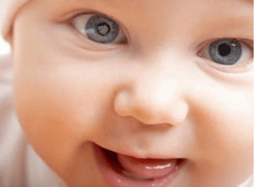 image of baby with Congenital Cataract