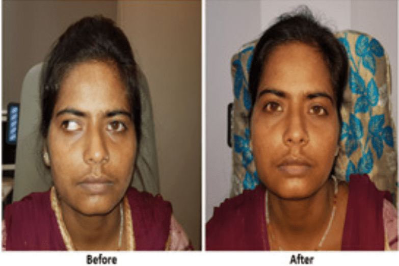 lady with squint eye treatment result at nandadeep eye hospital