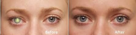 oculoplastic treatment result at nandadeep eye hospital