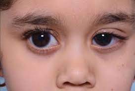 paediatric glaucoma disorder