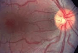 paediatric retina disorders