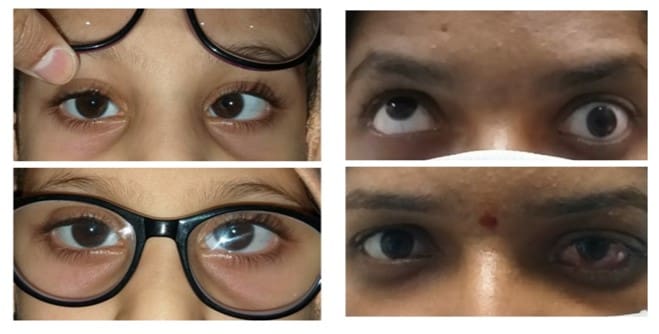 pediatric squint eye problem treatment