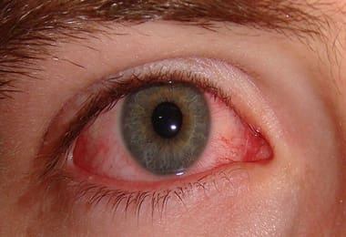 redness in eye dry eye symptom and treatment
