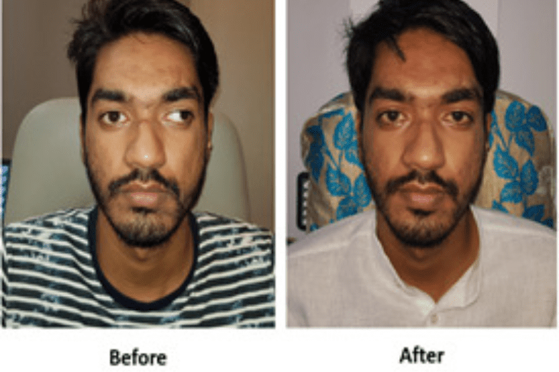 squint eye problem-refractive error treatment result at nandadeep eye hospital