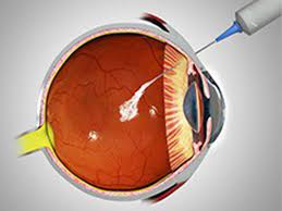 retina intravitreal injections