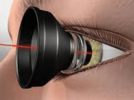 retina laser photocoagulation