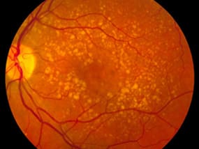 retinal disorder age-related-macular-degeneration