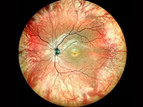 retinal disorder albinotic-fundus