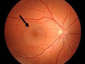 retinal disorder central-serous-retinopathy