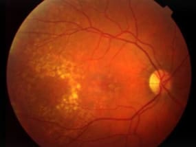 retinal disorder diabetic-retinopathy