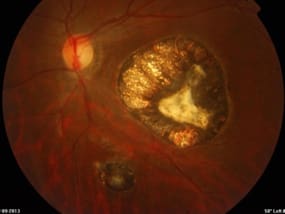 retinal disorder macular-scar