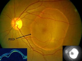 retinal disorder pigmented-epithelial-detachment
