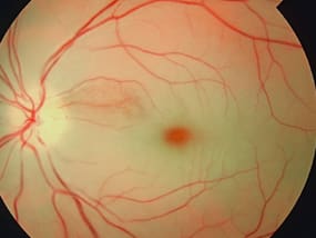retinal disorder retinal-artery-occlusion
