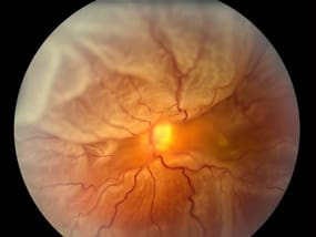retinal disorder retinal-detachment