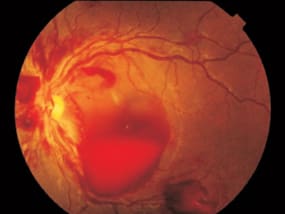 retinal disorder retinal-haemorrhage