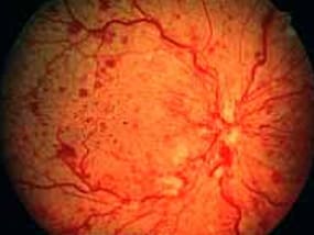 retinal disorder retinal-vein-occlusion