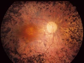 retinal disorder retinitis-pigmentosa