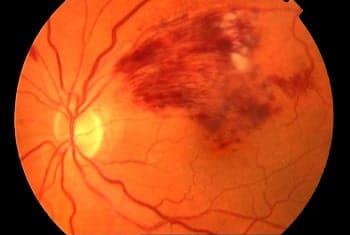 retinal vascular occlusion treatment at Nandadeep eye hospital