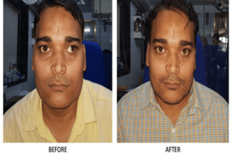 squint eye problem treatment result at nandadeep eye hospital