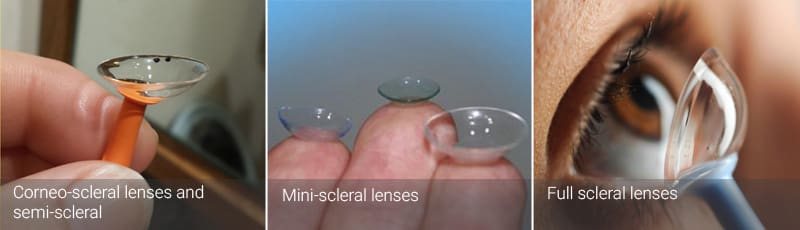 type of lenses- cornea-scleral lenses