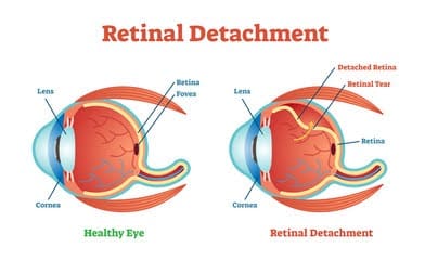 Retinal holes blog image