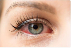 Ocular Allergies