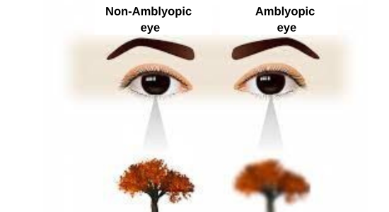 Amblyopia