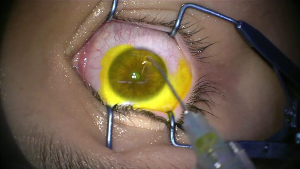 C3R (Corneal Collagen Cross-linking)