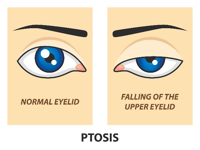 Common Conditions Addressed by Oculoplasty