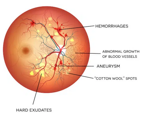 Diabetic Retinopathy