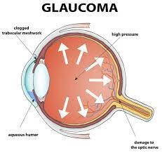 Glaucoma