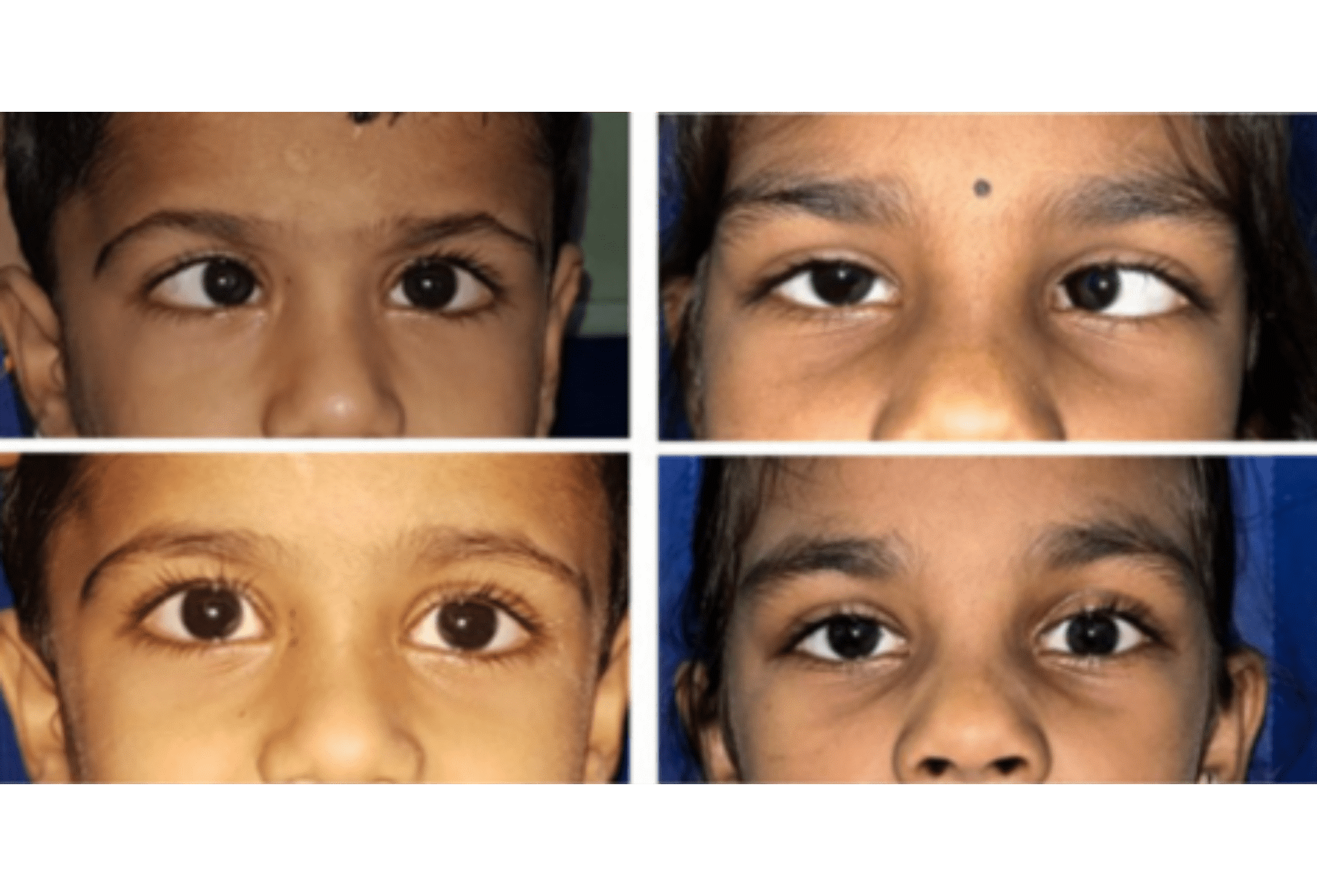 Paediatric Strabismus