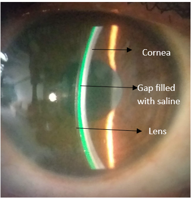 Understanding Specialty Contact Lenses