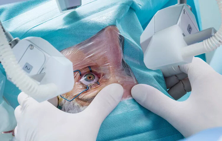 Anesthesia Cataract