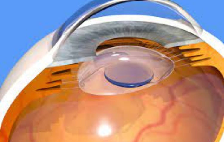 Artificial Lens Implantation