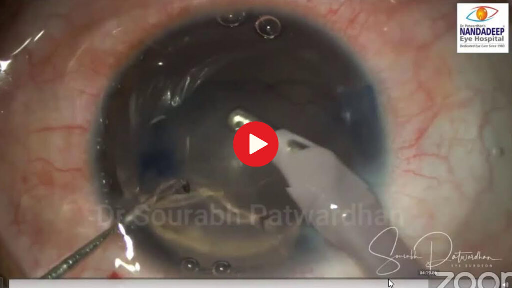 Cataract surgery in silicone oil