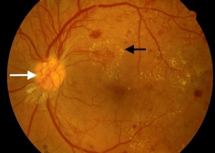 Diabetic Retinopathy