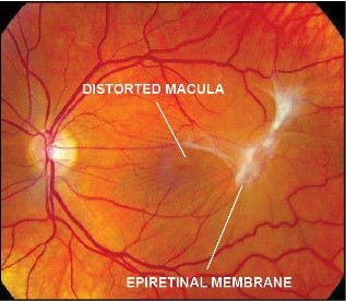 Epiretinal membrane