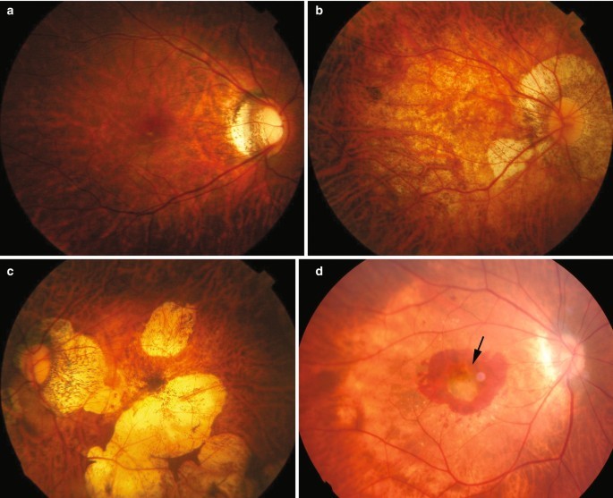 Eye Problems Associated with High Myopia